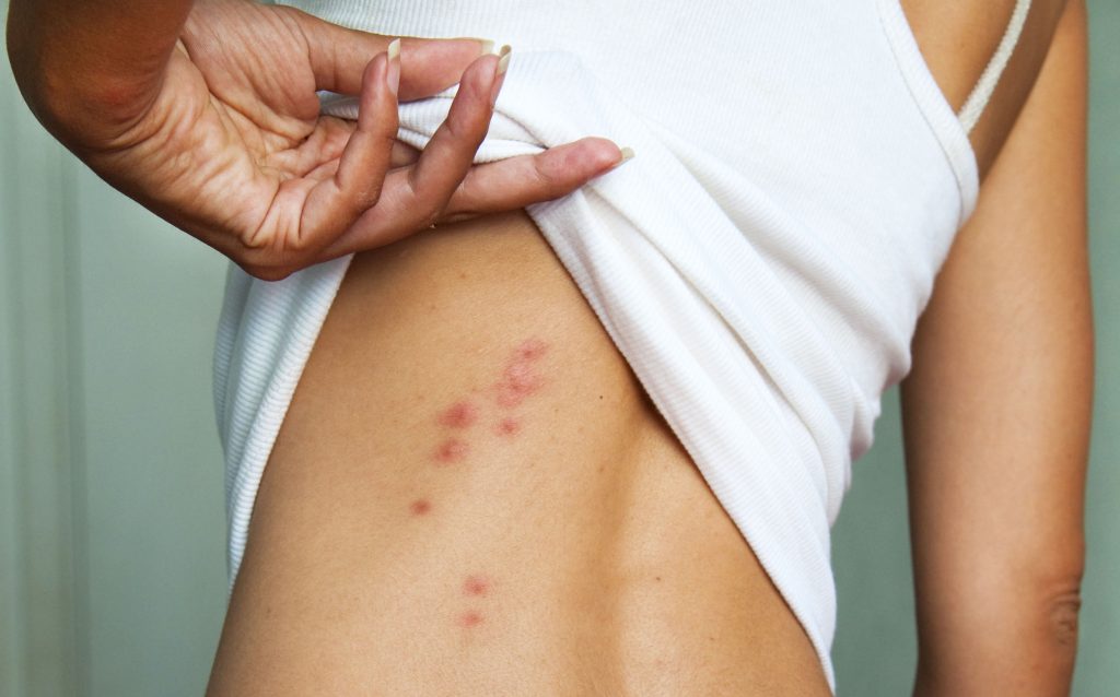 bed bug bites on a woman's back
